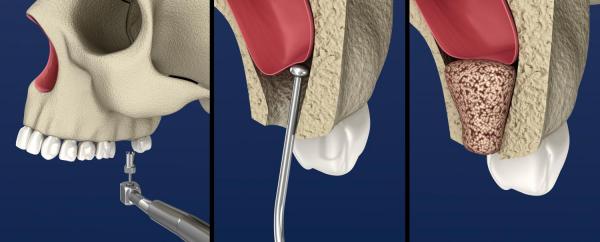 Sinus Lifting